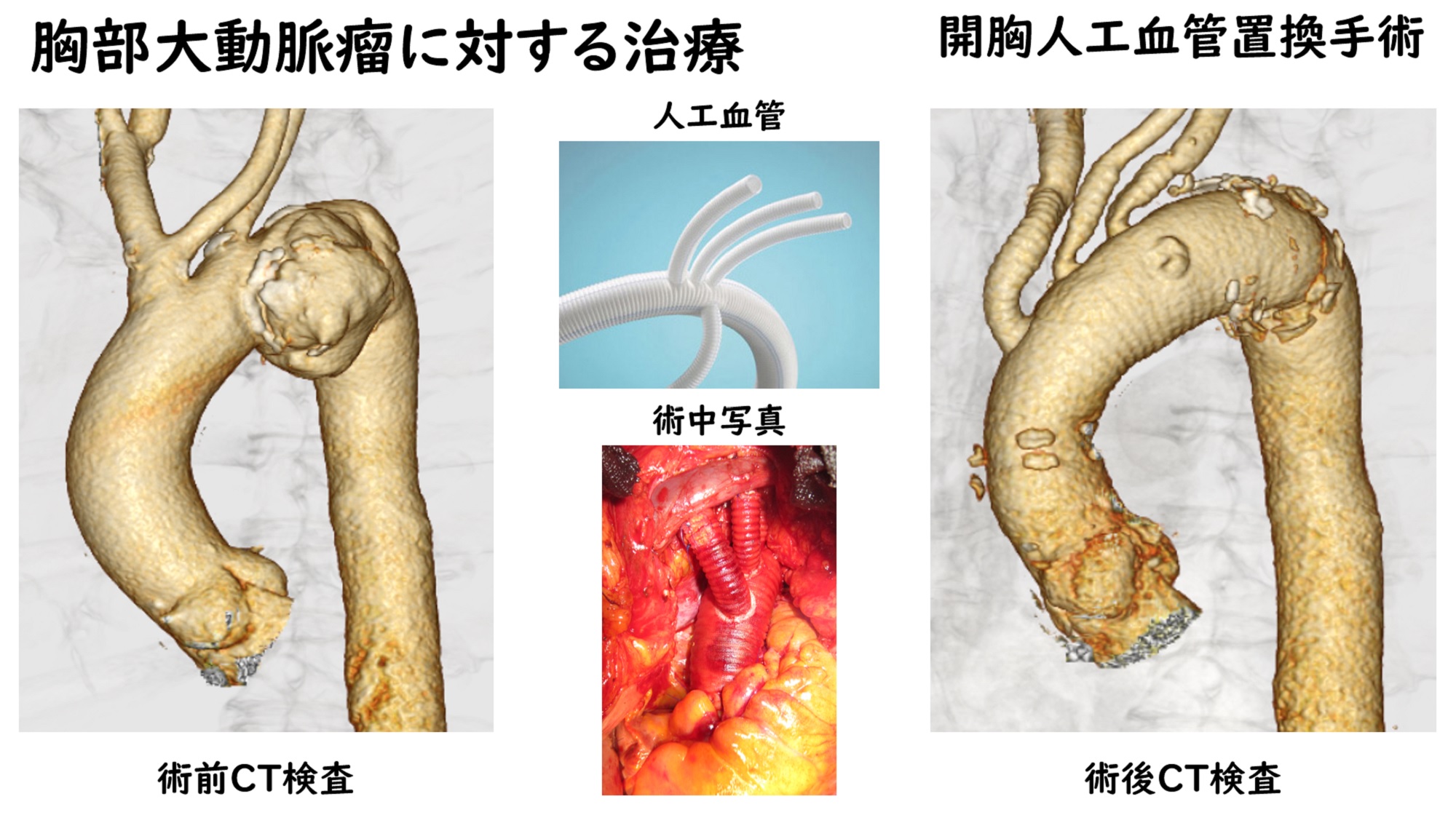 胸部大動脈瘤に対する治療－開胸人工血管置換手術