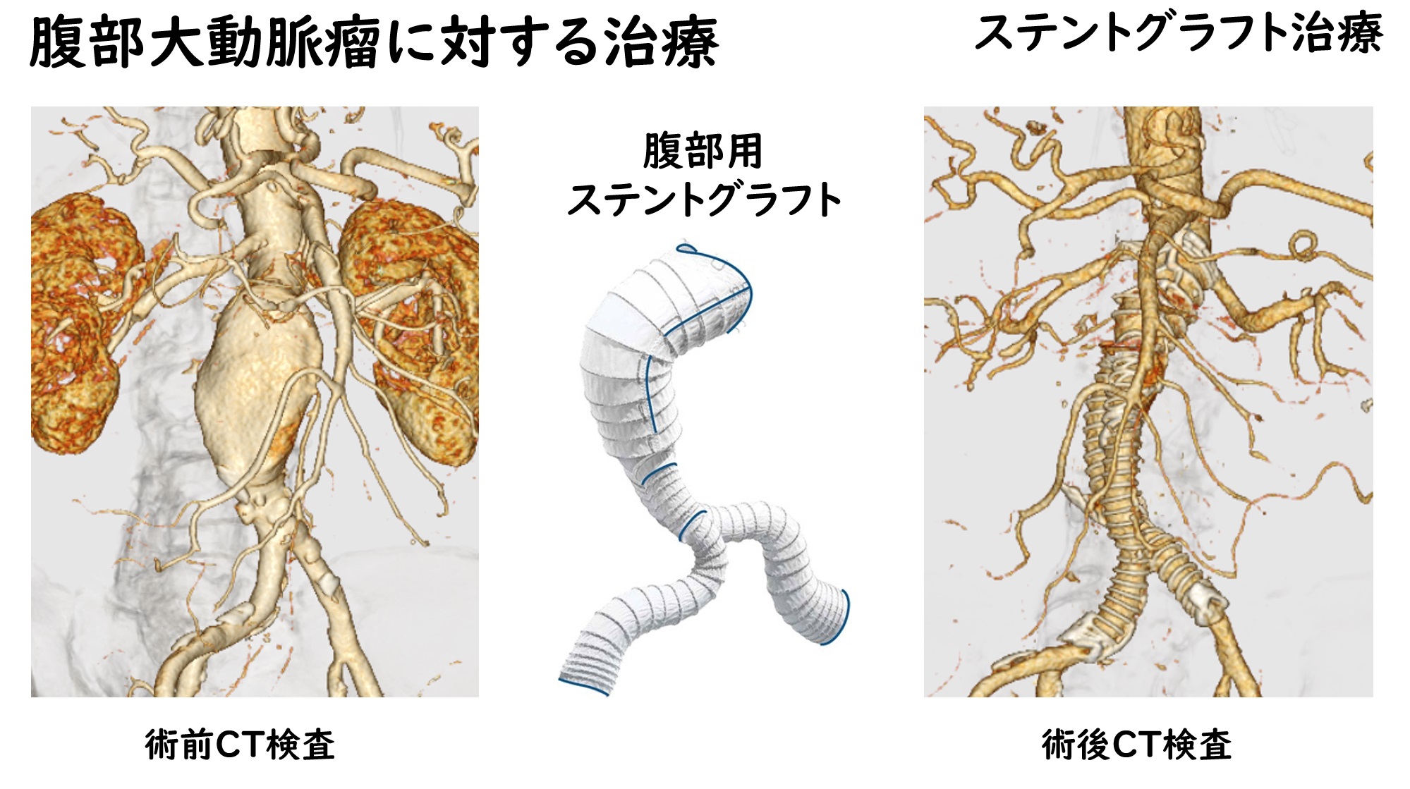 腹部大動脈瘤に対する治療－ステントグラフト治療