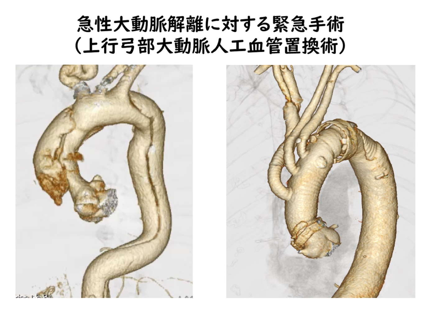 急性大動脈解離に対する緊急手術（上行弓部大動脈人工血管移管術）