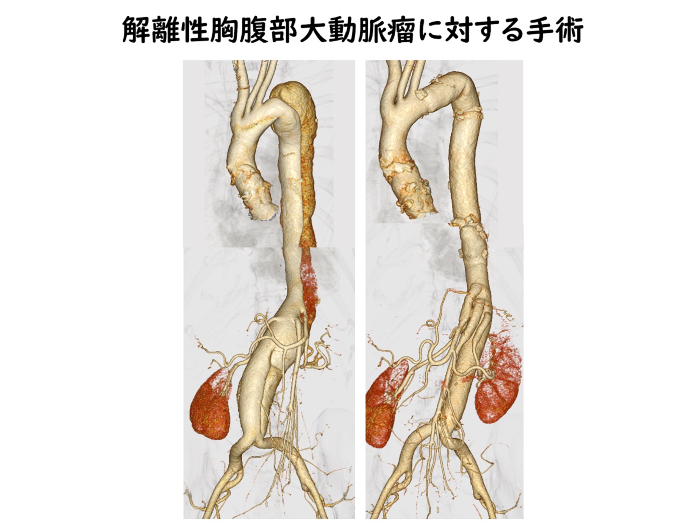 解離性胸腹部大動脈瘤に対する手術