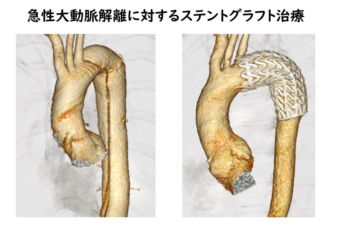 急性大動脈解離に対するステントグラフト治療