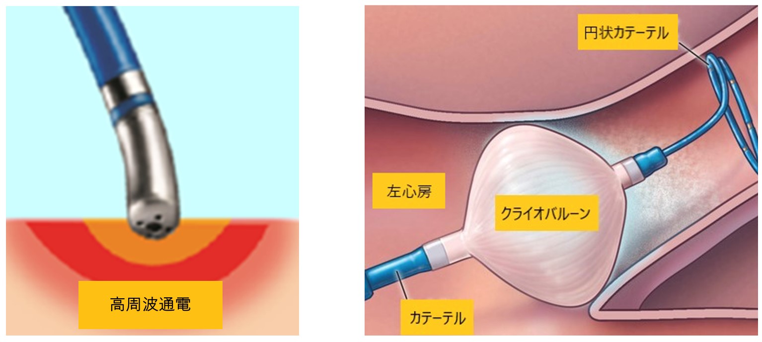 カテーテルアブレーション（経皮的カテーテル心筋焼灼術）とは