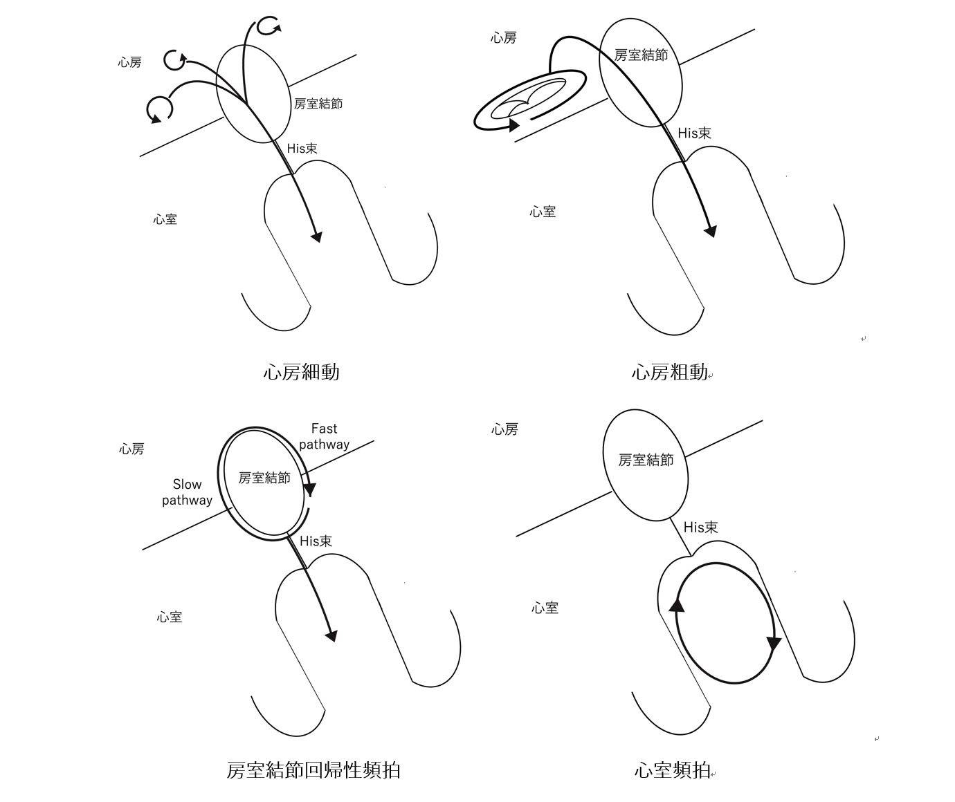 対象となる頻脈性不整脈