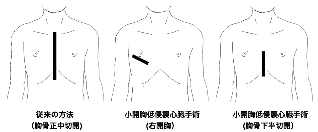 ＭＩＣＳ（ミックス）－小開胸低侵襲心臓手術