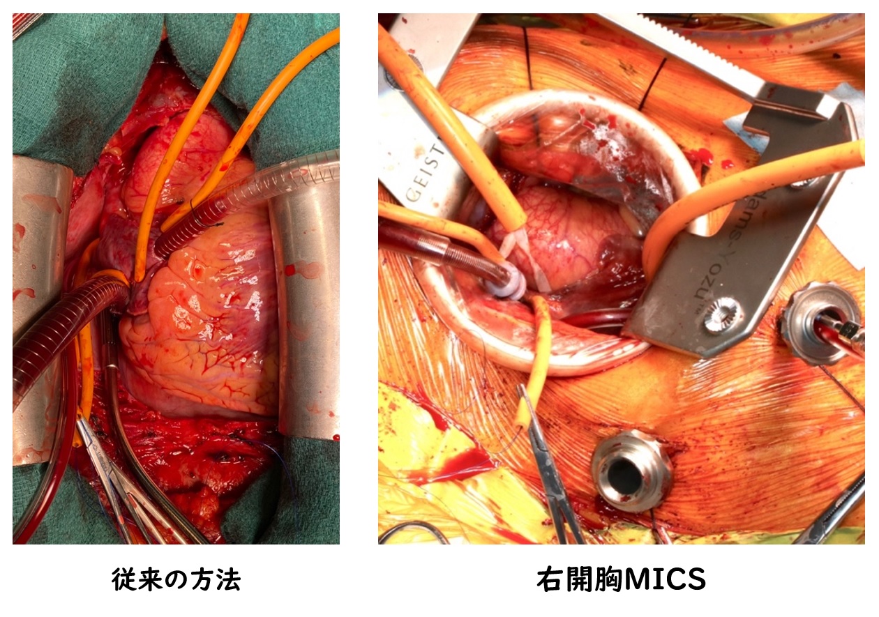 ＭＩＣＳ（ミックス）－小開胸低侵襲心臓手術