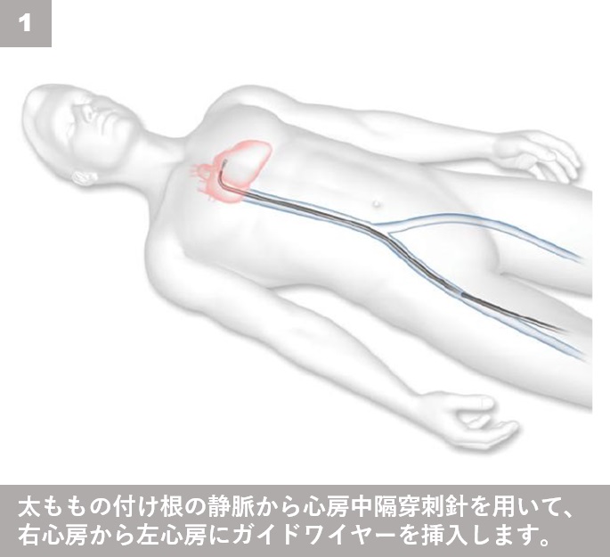 MitraClip－経皮的僧帽弁接合不全修復術 治療ステップ１