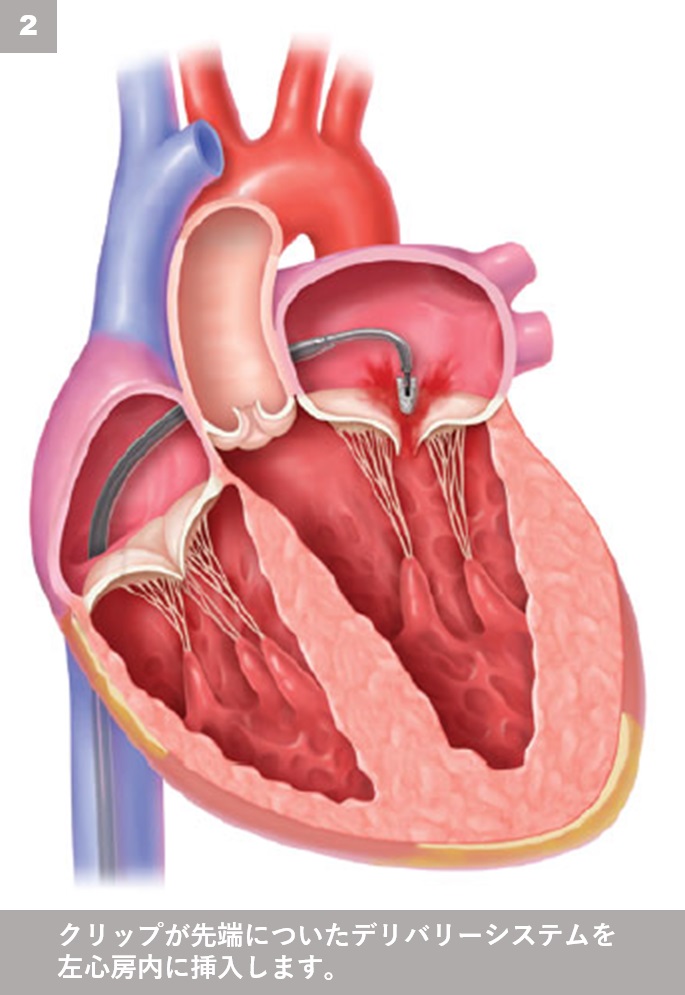 MitraClip－経皮的僧帽弁接合不全修復術 治療ステップ２