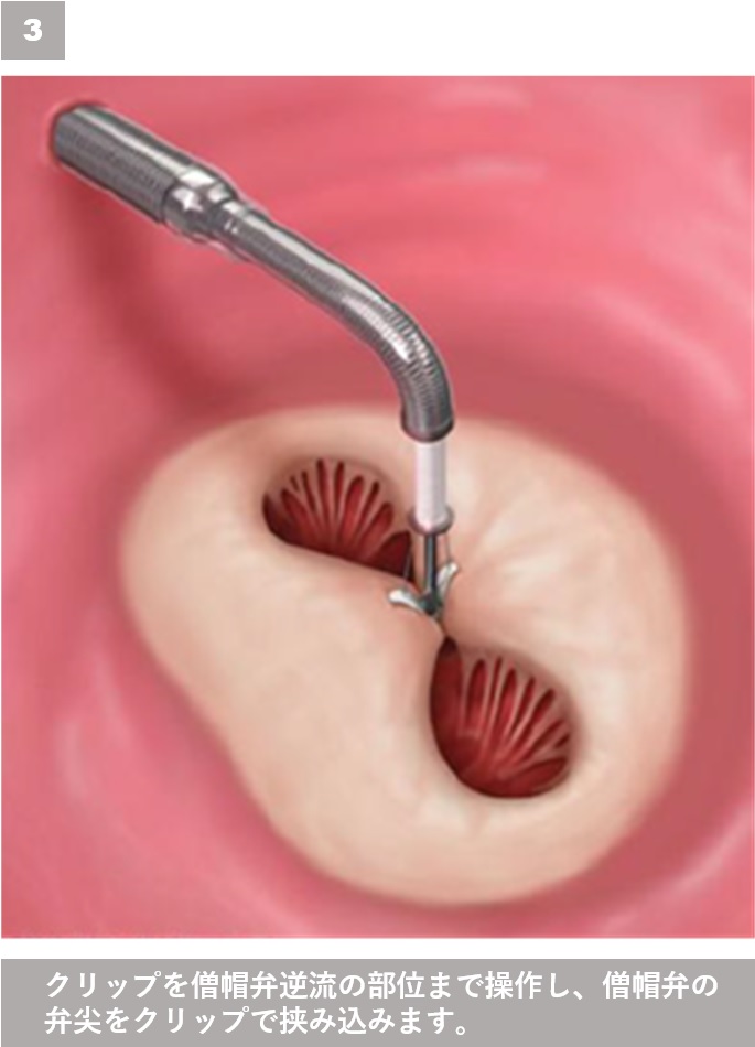 MitraClip－経皮的僧帽弁接合不全修復術 治療ステップ３