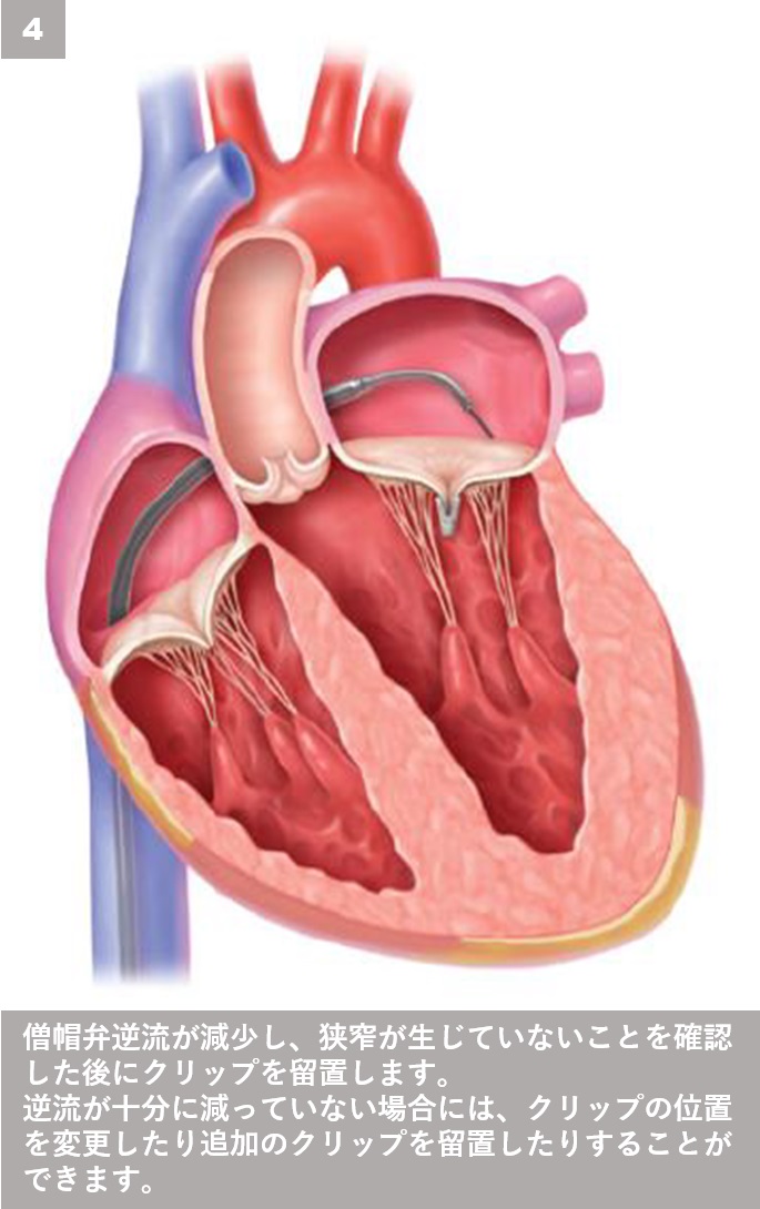 MitraClip－経皮的僧帽弁接合不全修復術 治療ステップ４