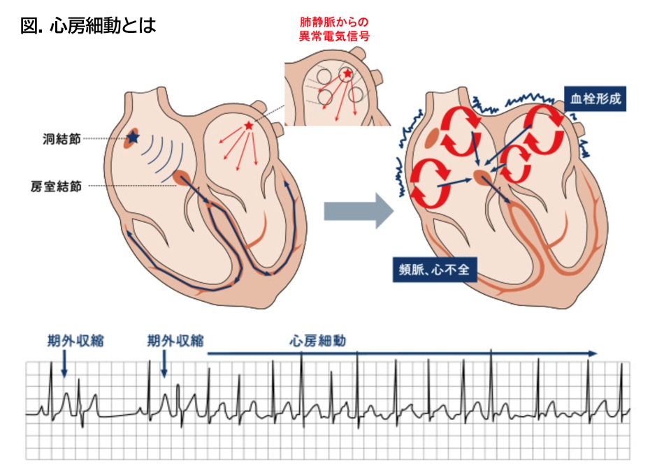 図. 心房細動とは－心房細動に対するパルスフィールドアブレーション（Pulse Field Ablation: PFA）