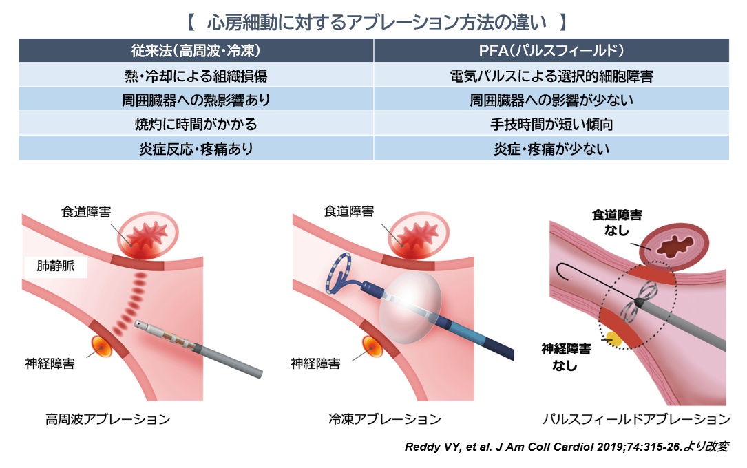 図. 心房細動に対するアブレーション方法の違い－心房細動に対するパルスフィールドアブレーション（Pulse Field Ablation: PFA）