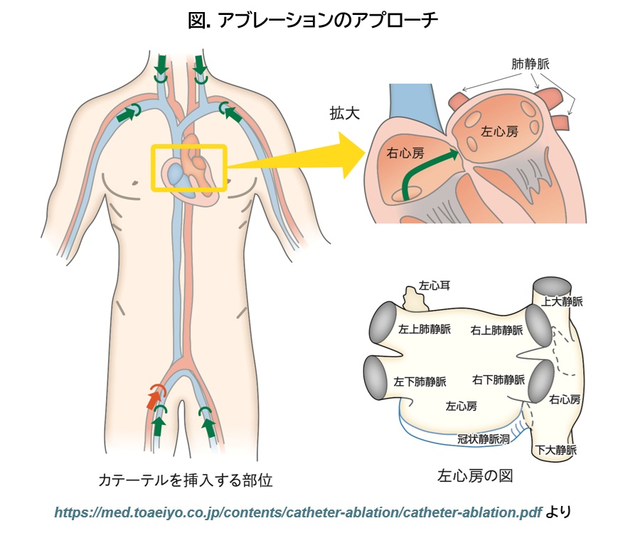 図. アブレーションのアプローチ－心房細動に対するパルスフィールドアブレーション（Pulse Field Ablation: PFA）