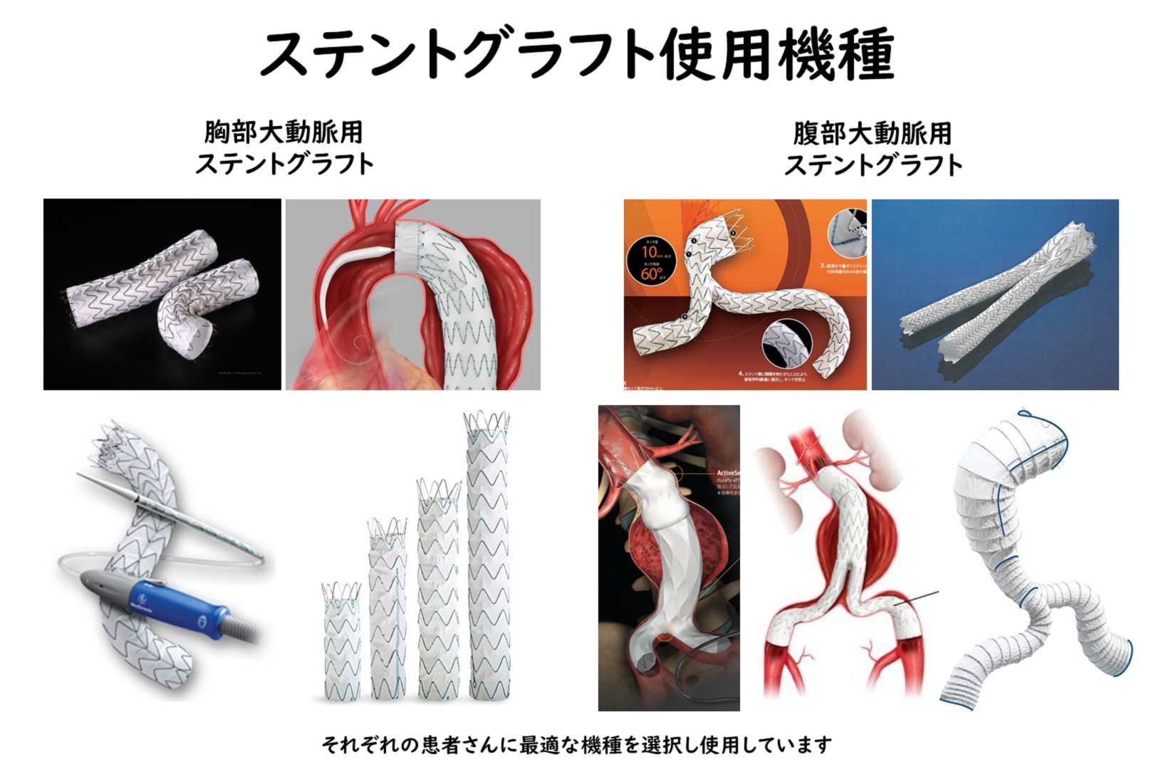 使用機器－ステントグラフト治療