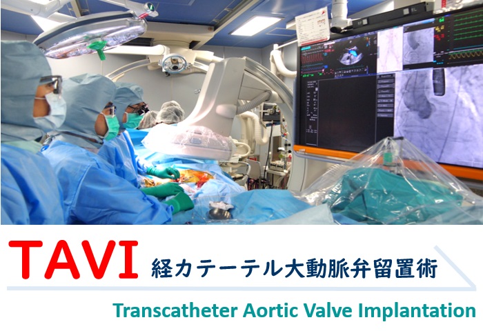 TAVI（経カテーテル 大動脈弁留置術）