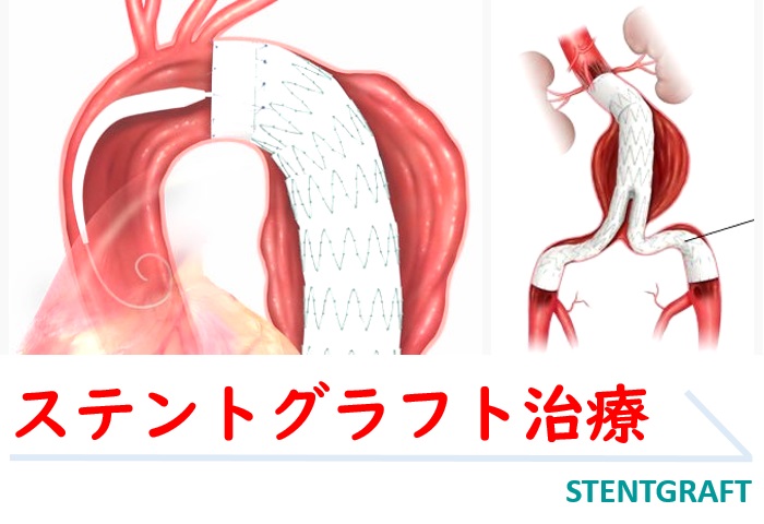 ステントグラフト治療